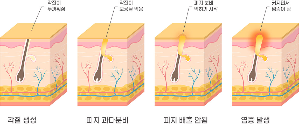 여드름 발생순서 1 각질이 두꺼워짐 2 각질이 모공을 막음 3 피지 분비 막히기 시작 4 커지면서 염증이 된다
