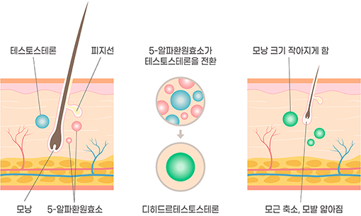 탈모진행과정